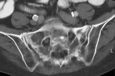 Bilateral insufficiency fractures in an oncology patient